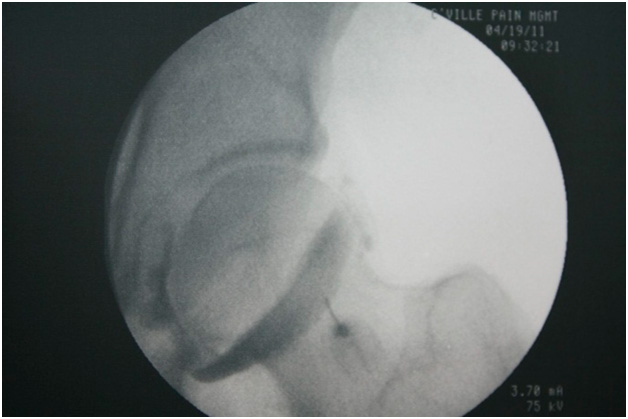 intra articular hip injection technique