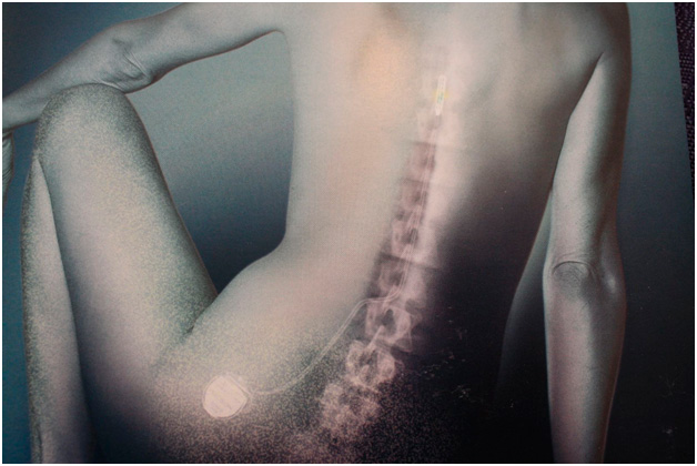 Spinal Cord Stimulation for Pain: Am I a Candidate?