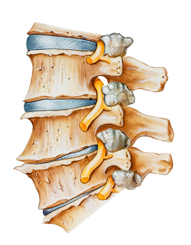 what-is-degenerative-disc-disease